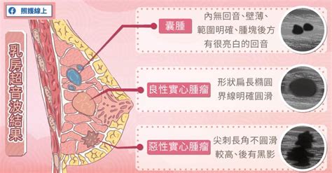 胸部有毛|乳頭邊長了毛，是什麼病？該不該拔？讓名醫一次解釋給您聽｜每